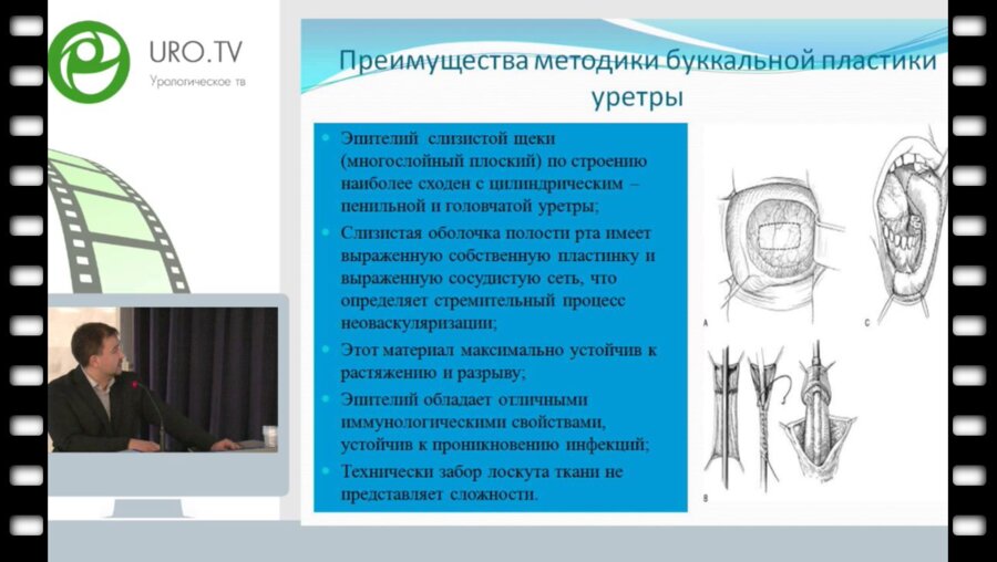 Титов Д.В. - Реконструктивные операции на мочеиспускательном канале у детей с использованием лоскута из слизистой щеки