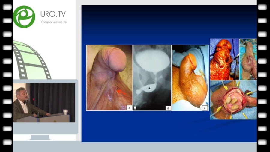 Файзулин А.К. - Результаты оперативного лечения проксимальных форм гипоспадии методами тканевой инженерии в комбинации с уретропластикой по методике Onlay-tube