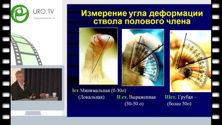 Рудин Ю.Э. - Сравнение результатов лечения одномоментной пластики уретры тубуляризированным лоскутом крайней плоти и двухэтапной пластики уретры