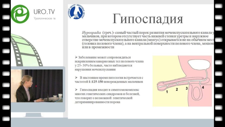 Стрижова Д.Н. - Клинический случай удвоения полового члена у ребенка с проксимальной формой гипоспадии