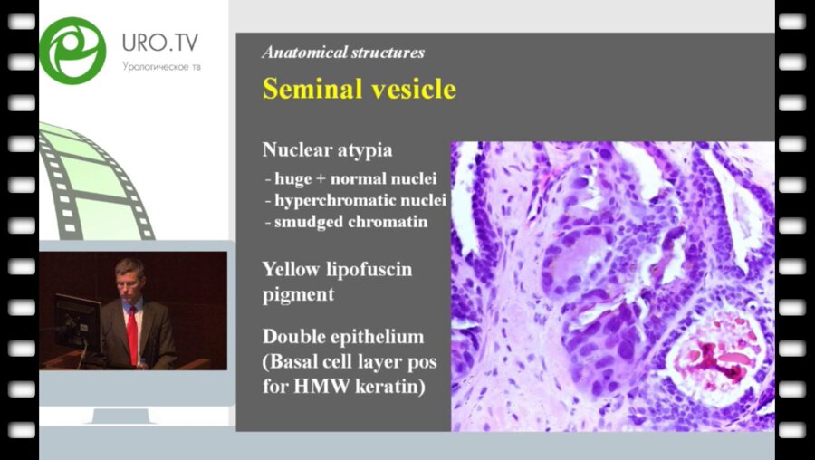 Lars Egevad - Макроскопическое и микроскопическое описание рака предстательной железы