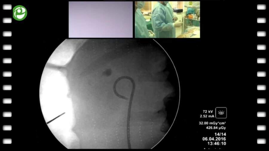 Перкутанная ультрамининефролитотрипсия слева