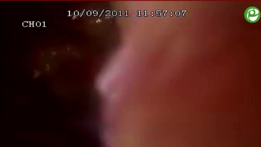 Лапароскопическая радикальная простатэктомия