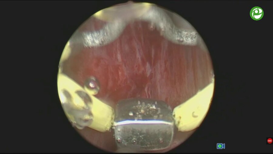 Биполярная электроэнуклеация гиперплазии простаты