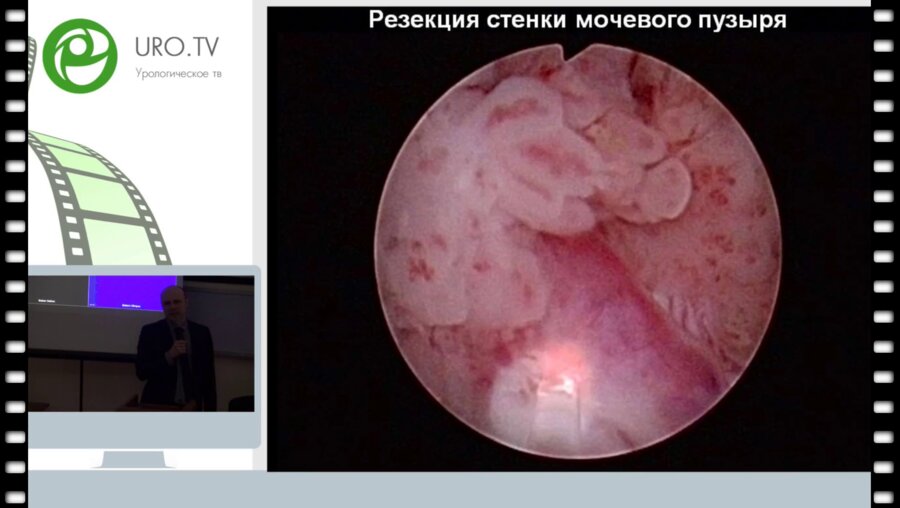 Бурлака О.О. - Неклассическое использование гольмиевого лазера