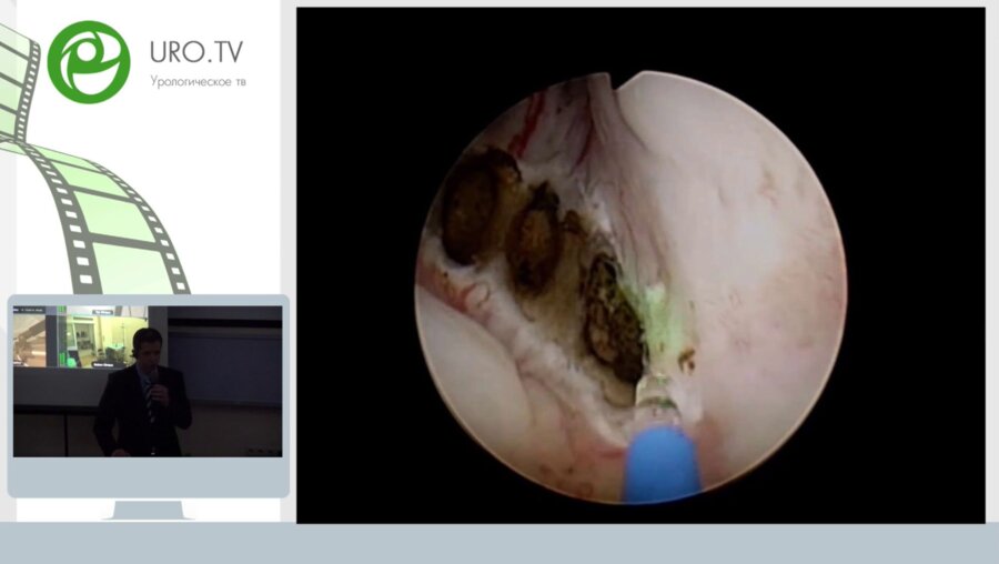 Завтрак с экспертами. Тулиевая лазерная хирургия - альтернатива или прогресс?