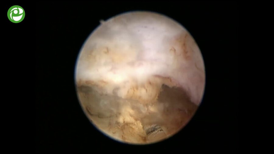 Секция живой хирургии: Энуклеация гиперплазии простаты.