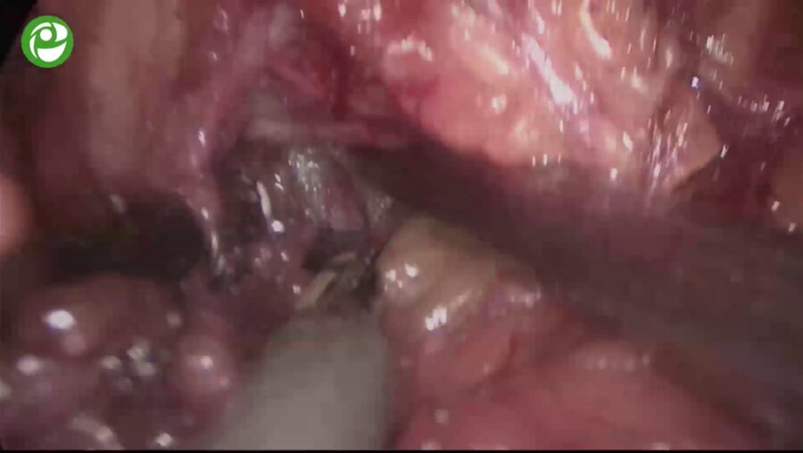 Секция живой хирургии: Простатэктомия.