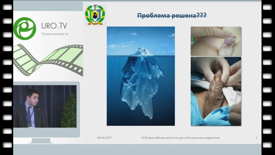 Агзамходжаев С.Т. - Использование влагалищной оболочки яичка при хирургическом лечении послеоперационных осложненений гипоспадии у детей