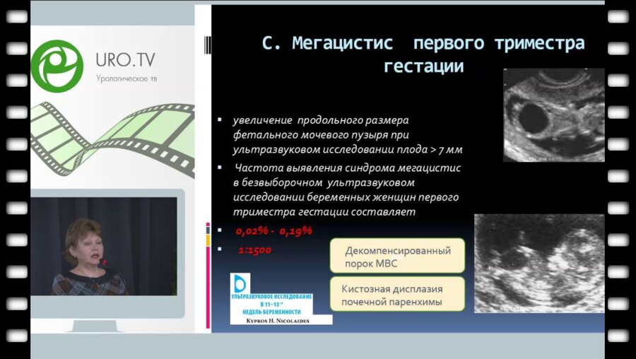 Дерюгина Л.А. - Морфофункциональное сотояние мочевого пузыря у плодов 1-3 триместром геста­ции в норме