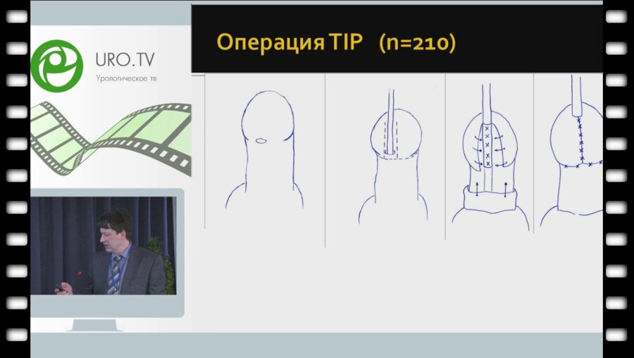 Жарков Д.А. - Результаты хирургического лечения дистальной формы гипоспадии