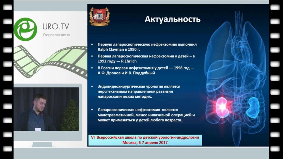 Основин П.Л. - Лапароскопическая нефрэктомия у детей