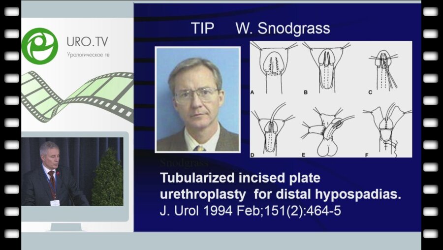 Рудин Ю.Э. - Наш подход к коррекции гипоспадии у детей. Целесообразно ли унифициро­вание методик?