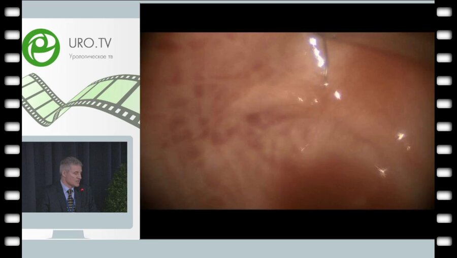 Рудин Ю.Э. - Пневмовезикоскопическая реимплантация мочеточника у детей с мегауретером