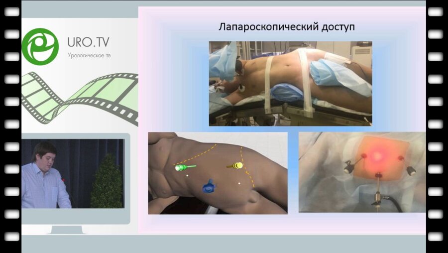 Струянский К.А. - Сравнительная оценка эндоскопических доступов при простом врожденном гидронефрозе у детей