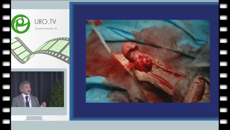 Файзулин А.К. - Варианты хирургического лечения детей с осложненными формами гипоспадии