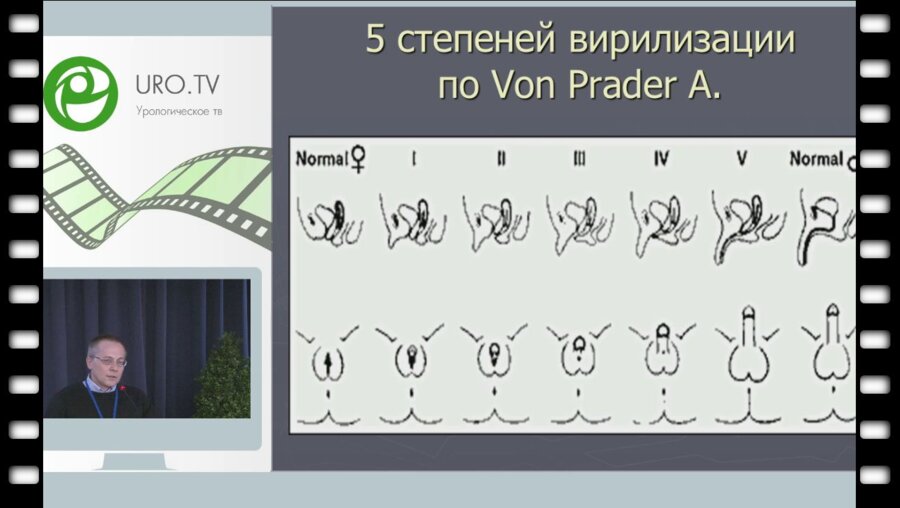 Шибеко Е.В. - Опыт феминизирующих операций при нарушении полового развития у девочек