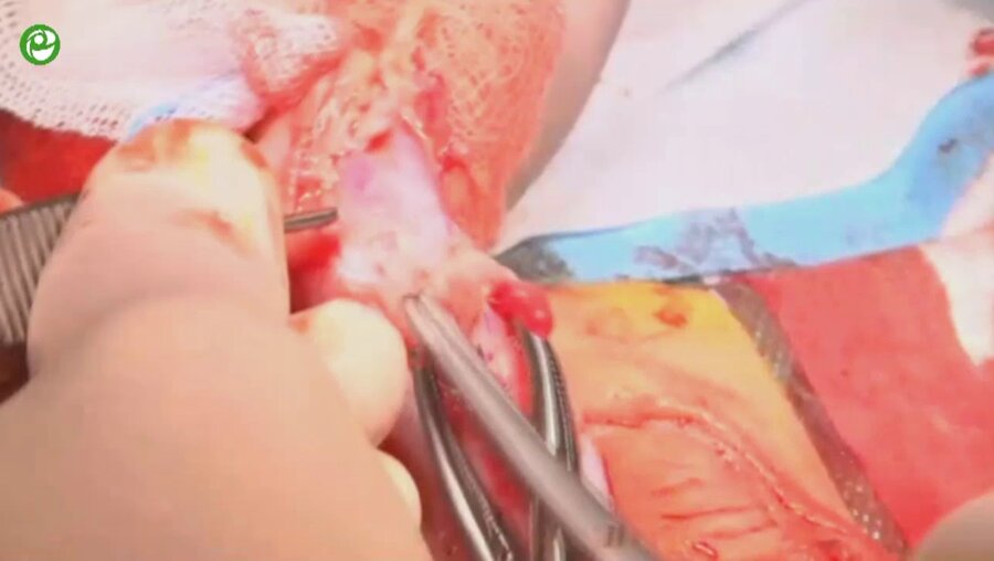 Одномоментная пластика уретры (onlay-tube-onlay)