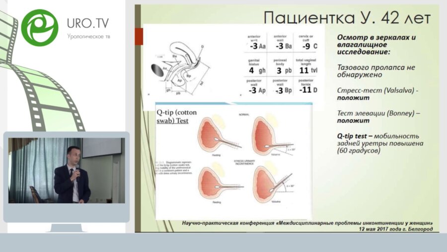 Обтураторный слинг синтетической петлей при стрессовой инконтиненции