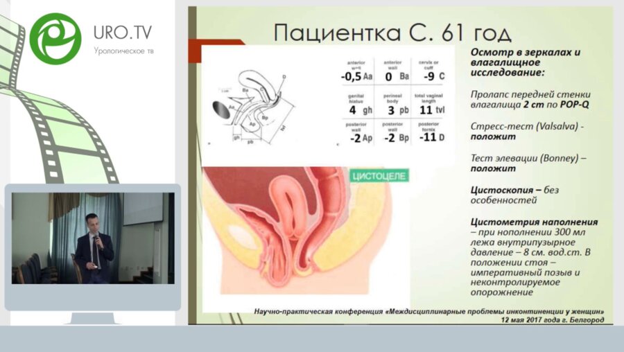 Передняя кольпорафия. Трансобтураторный субуретральный слинг свободной синтетической петлей