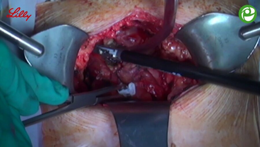 Оперативное вмешательство: позадилонная аденомэктомия. Велиев Е.И.