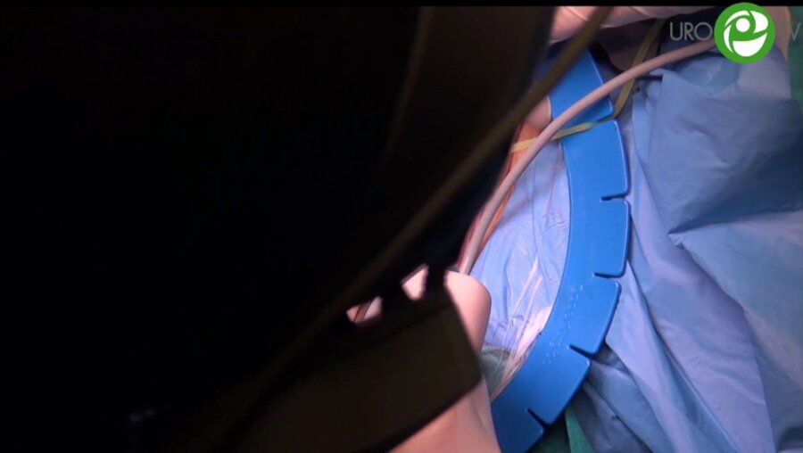 Анастомотическая пластика конец в конец - Котов С.В.