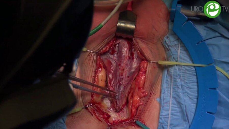 Уретроцистонеоанастамоз с фистулопластикой у пациента с пузырно-ректальным свищом - Котов С.В.