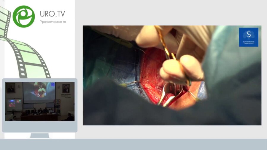 Бутнару Д.В., Безруков Е.А., Еникеев М.Э. - Видеосессия Живая хирургия