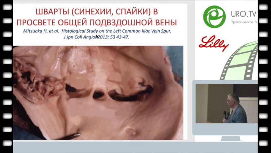 Капто А.А. - Артериовенозные конфликты у мужчин с урологической патологией