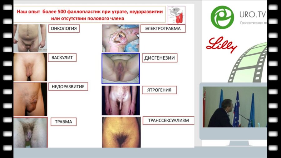 Адамян Р.Т. - Фаллопротезирование при утрате полового члена