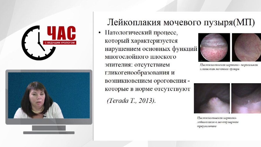 Час с ведущим урологом. Лейкоплакия мочевого пузыря: диагностика, лечебные подходы в свете доказательной медицины