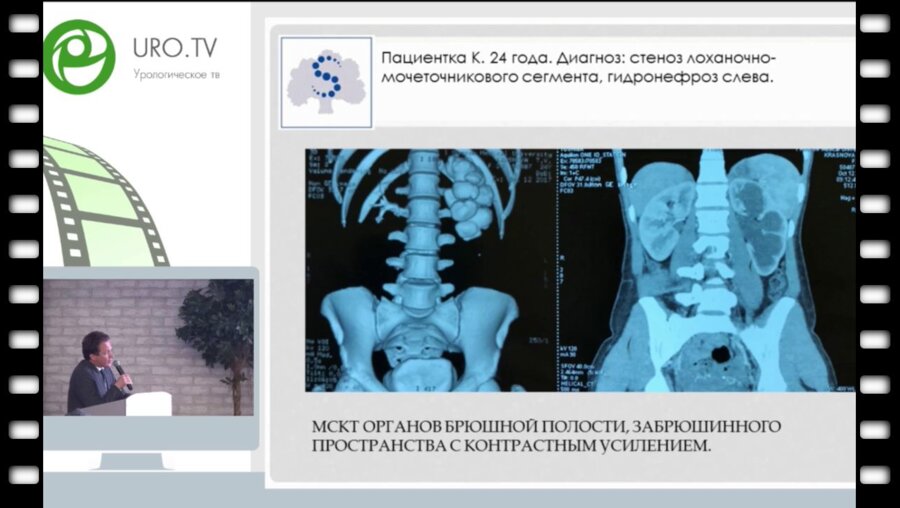 Шпоть Е.В. - Лапароскопическая уретерокаликостомия