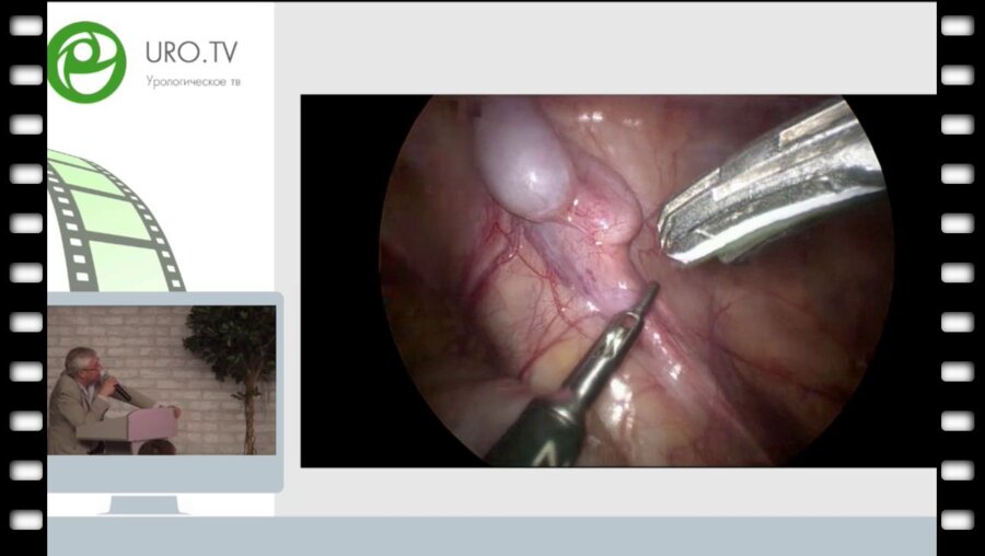 Сизонов В.В. - Модифицированный 2 этап фовлера