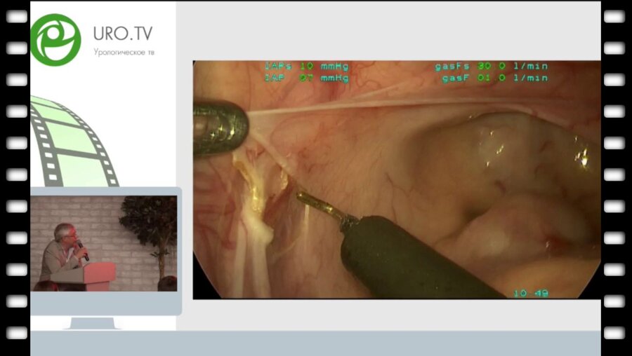 Сизонов В.В. - Антирефлюксная операция грегуара лапараскопическим доступом