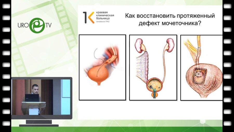 Лалетин Д.И. - Случай аппендикулоуретеропластики справа