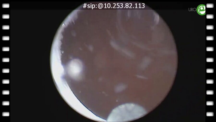 Болгов Е. Н. - Трансляция из операционной Тулиевая энуклеация простаты  – трехдолевая методика