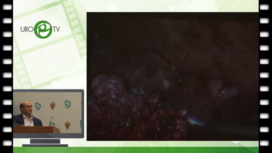 Гебенов М. Х.  - Лапароскопическая резекция при синхронном двустороннем опухолевом поражении