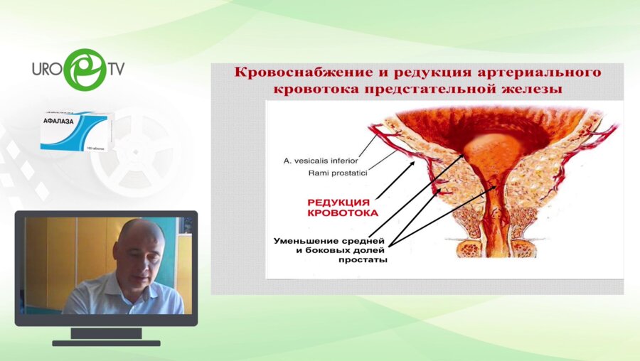 Курбатов Д.Г. - Эмболизация простатических артерий в лечении ДГПЖ