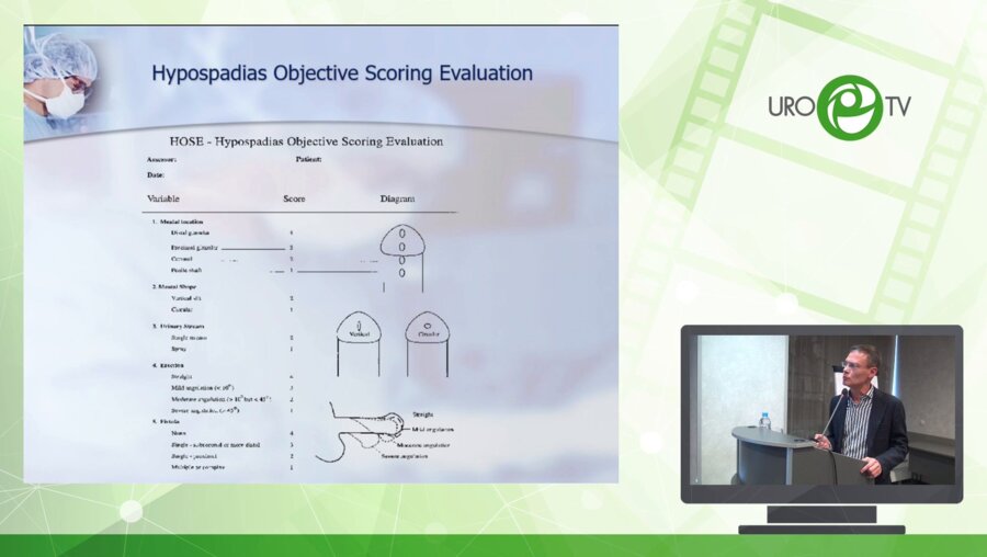 Батрутдинов Р.Т. - Уреопластика Inlay при первичной и повторной гипоспадии. Оценка результатов