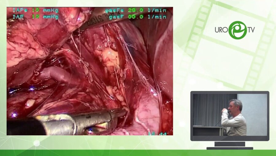 Бондаренко С.Г. - Лапароскопическая пиелопластика в сложных случаях гиперротированных почек у детей