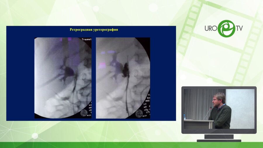 Демин Н.В. - Лапароскопическая аппедикоуретеропластика верхней трети у ребёнка 5 лет