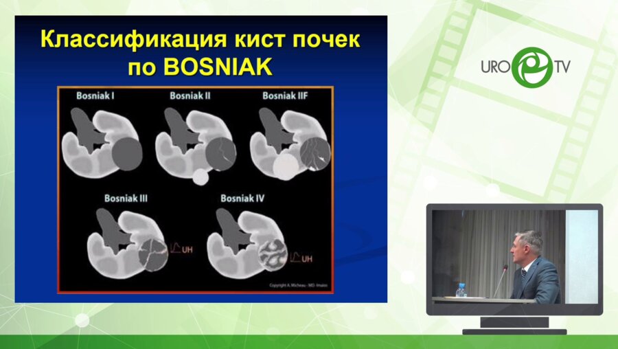 Рудин Ю.Э. - Резекция мультилокулярной кисты верхнего полюса правой почки у девочки 12 лет