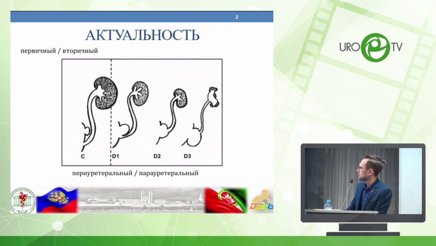 Хаертдинов Э.И. - Лапароскопическое удаление дивертикула мочевого пузыря и культи мочеточника