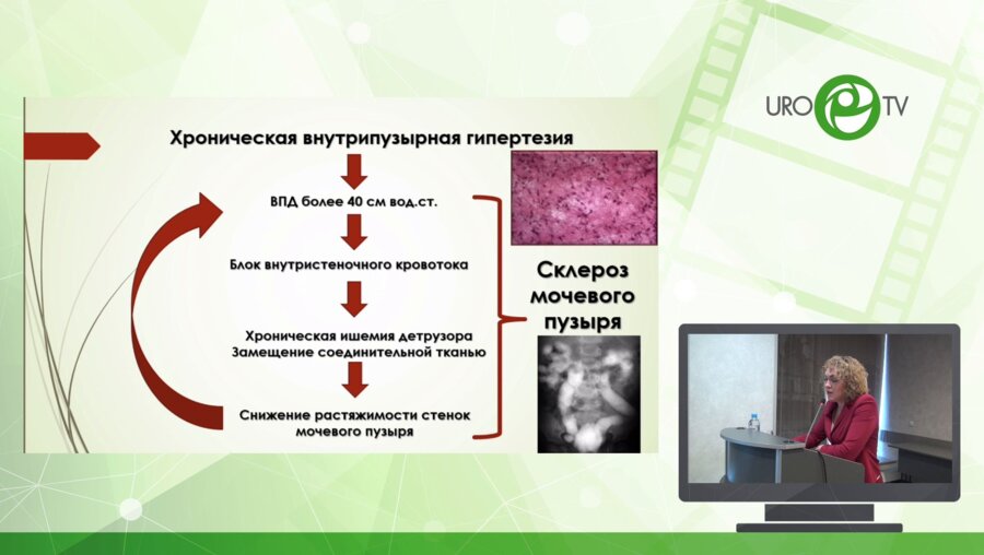 Щедрина А.Ю. - Применение ботулотоксина типа А в лечении редукции ёмкости и гиперактивности мочевого пузыря у детей