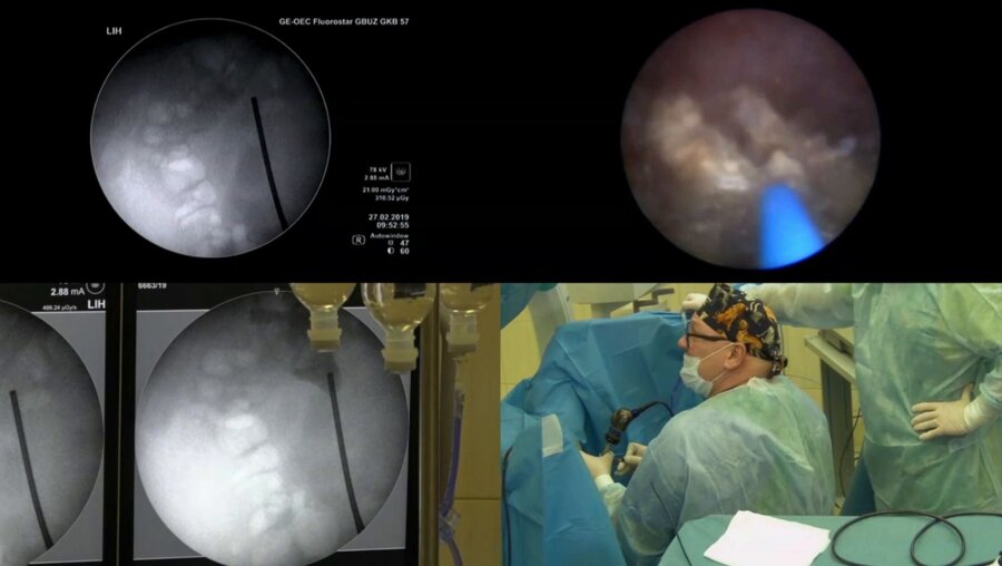 Мартов А.Г - Микроперкутанная тулиевая волоконная нефролитотрипсия