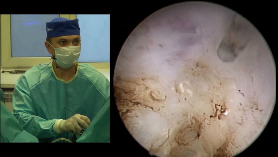 Сорокин Н.И. - Тулиевая волоконная энуклеация гиперплазии предстательной железы