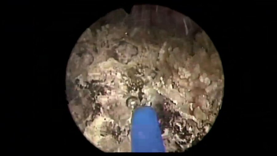 Суханов Р.Б. и Мартов А.Г. - Тулиевая волоконная цистолитотрипсия и Трансуретральная тулиевая фибронефролитотрипсия (RIRS)