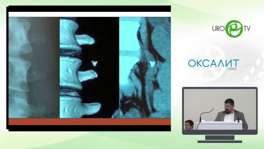 Мазуренко Д.А. - Камень верхней трети мочеточника  1 см - ДЛТ против Уретероскопии