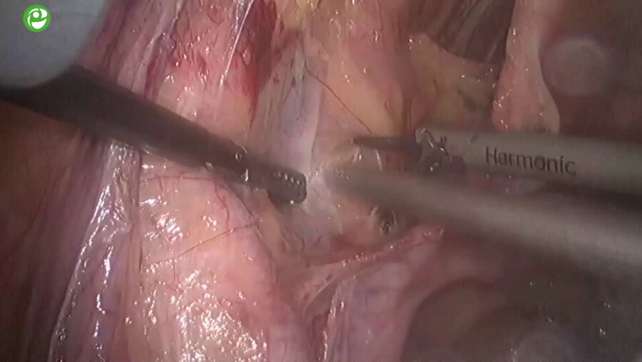 Галямов Э.А.  - Лапароскопическая простатэктомия 3D