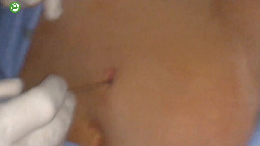 Носов А.К.  - Лапароскопическая резекция почки 3D